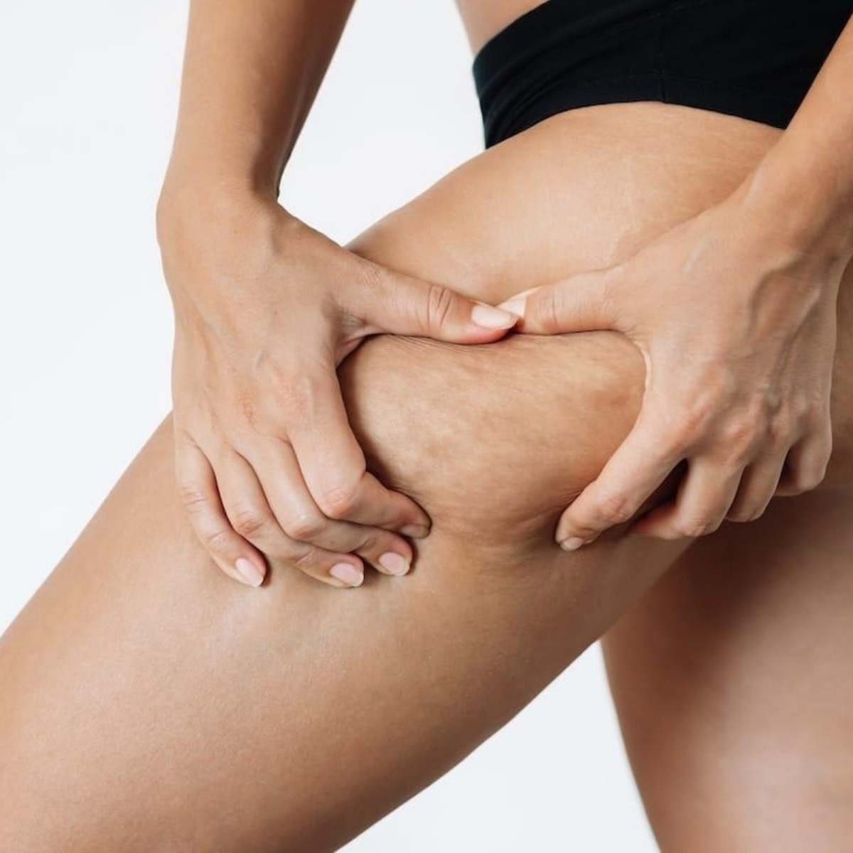 Cellulite e ritenzione